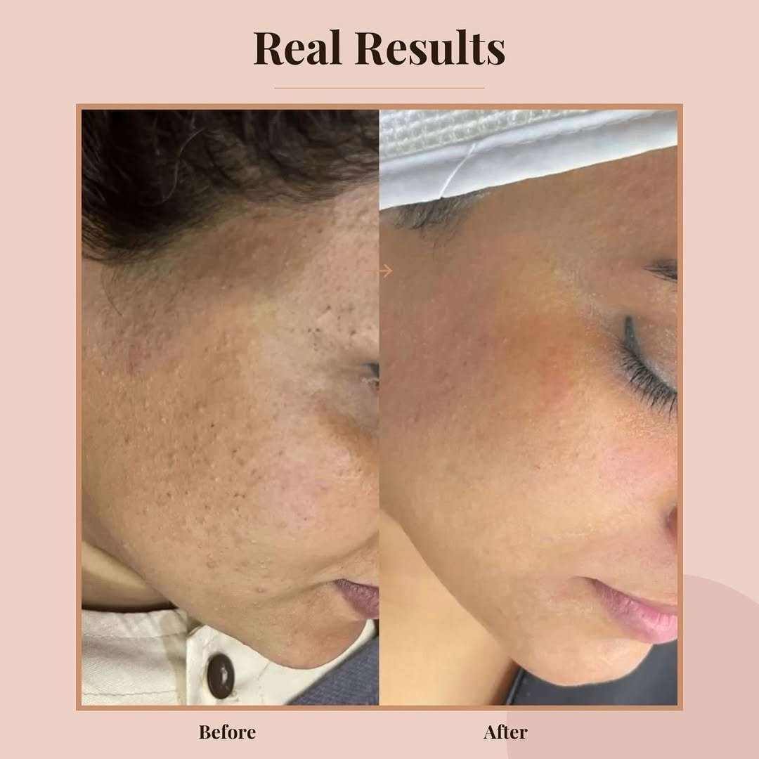 Voor-en-na resultaat van een huidbehandeling bij Bites of Beauty